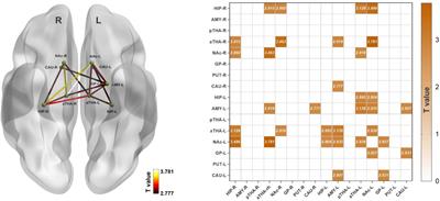 Aberrant resting-state functional connectivity and topological properties of the subcortical network in functional dyspepsia patients